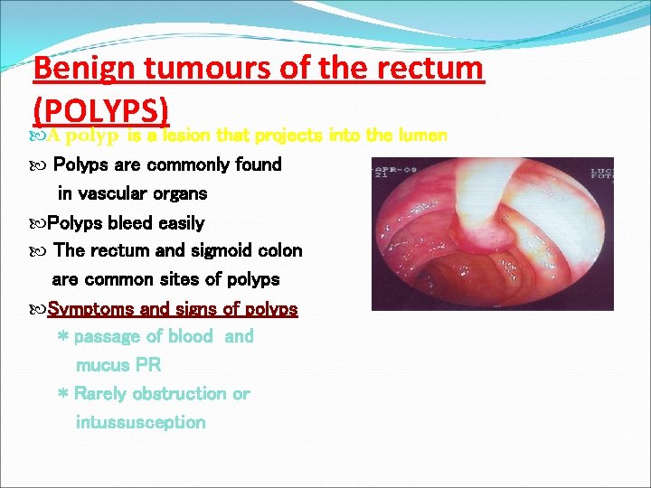 Benign tumours of the rectum (POLYPS) A polyp is a lesion that projects into
