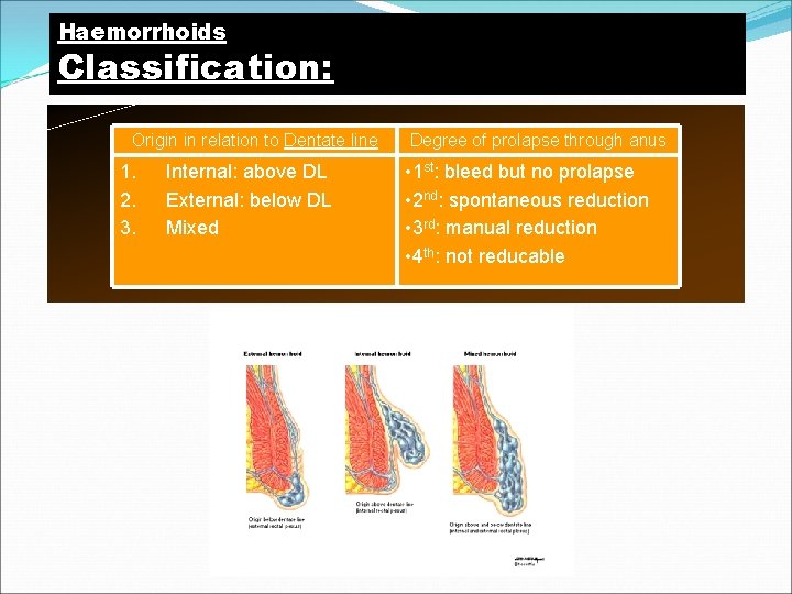 Haemorrhoids Classification: Origin in relation to Dentate line 1. 2. 3. Internal: above DL