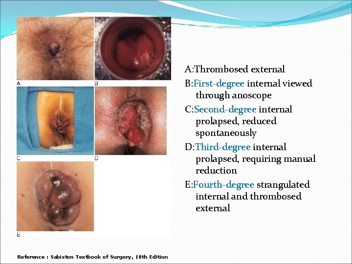 A: Thrombosed external B: First-degree internal viewed through anoscope C: Second-degree internal prolapsed, reduced