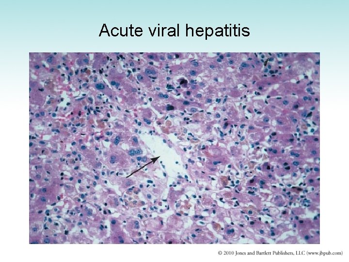 Acute viral hepatitis 
