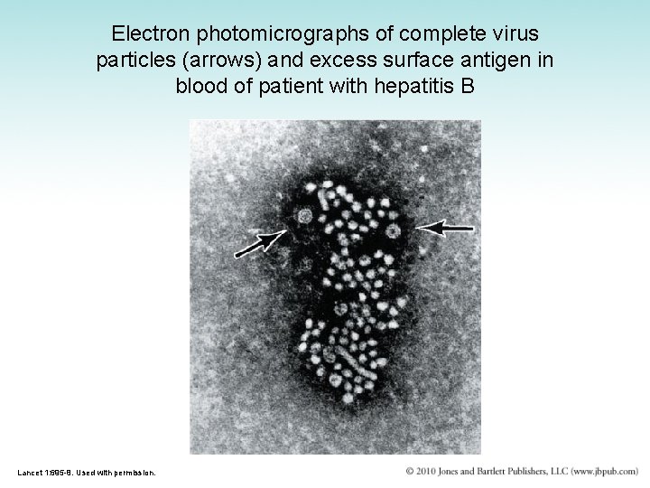 Electron photomicrographs of complete virus particles (arrows) and excess surface antigen in blood of