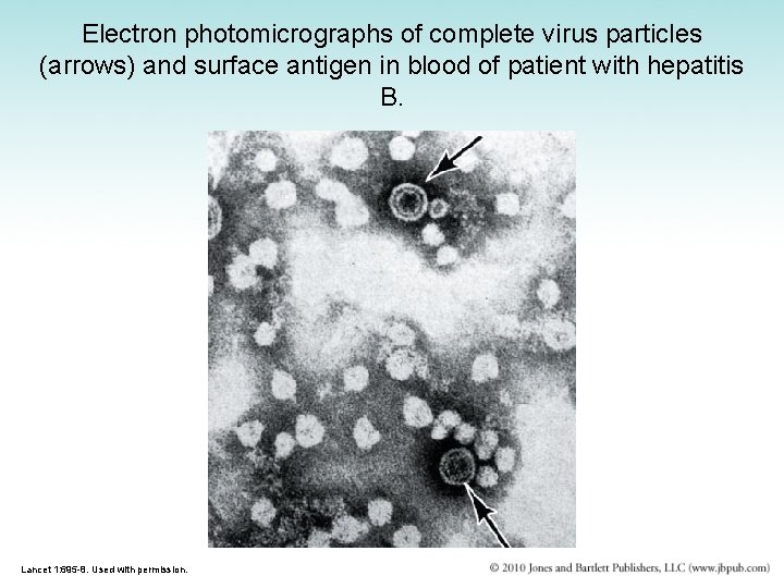 Electron photomicrographs of complete virus particles (arrows) and surface antigen in blood of patient