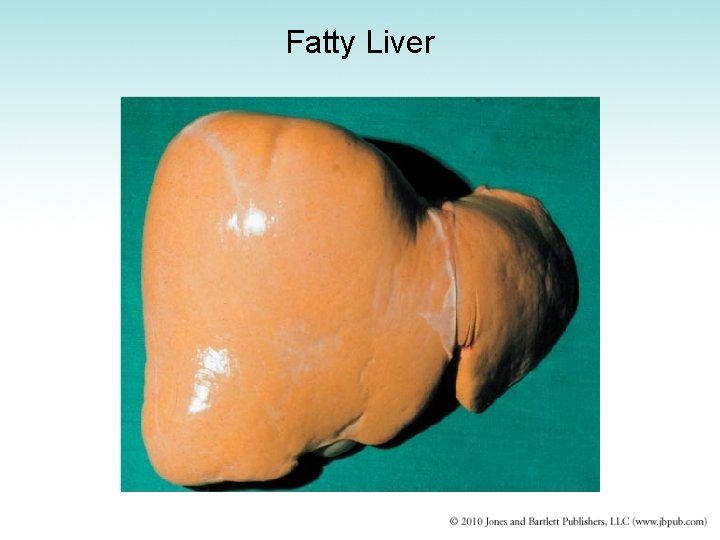 Fatty Liver 
