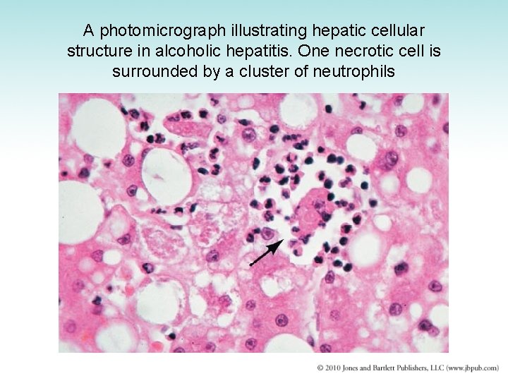 A photomicrograph illustrating hepatic cellular structure in alcoholic hepatitis. One necrotic cell is surrounded