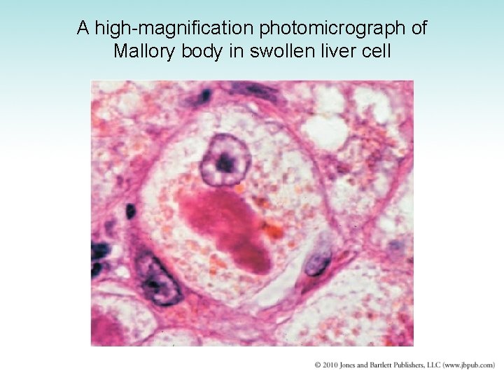 A high-magnification photomicrograph of Mallory body in swollen liver cell 