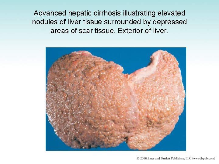 Advanced hepatic cirrhosis illustrating elevated nodules of liver tissue surrounded by depressed areas of