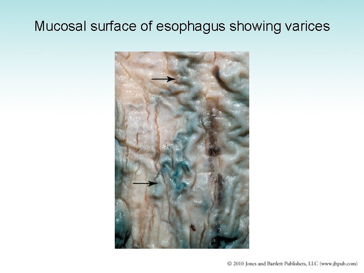 Mucosal surface of esophagus showing varices 
