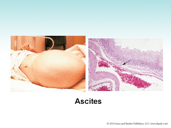 Ascites 