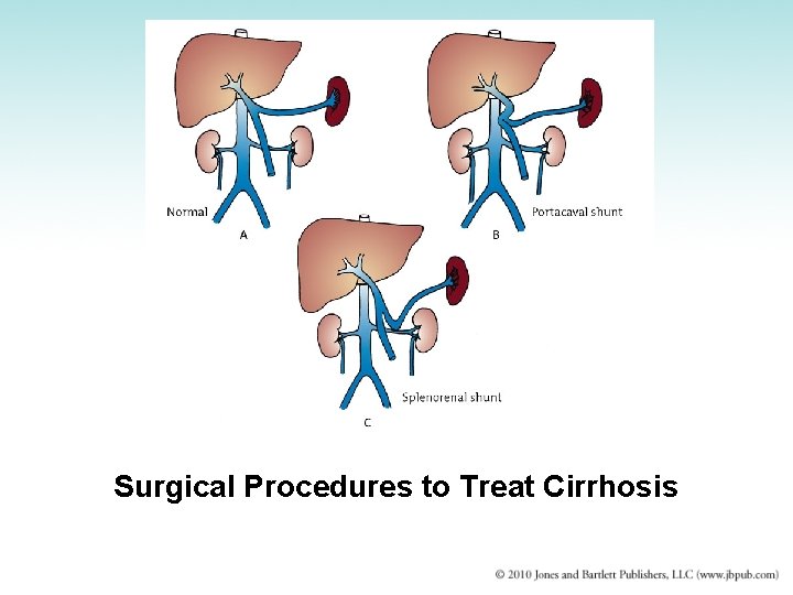 Surgical Procedures to Treat Cirrhosis 