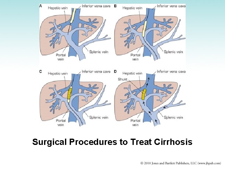 Surgical Procedures to Treat Cirrhosis 