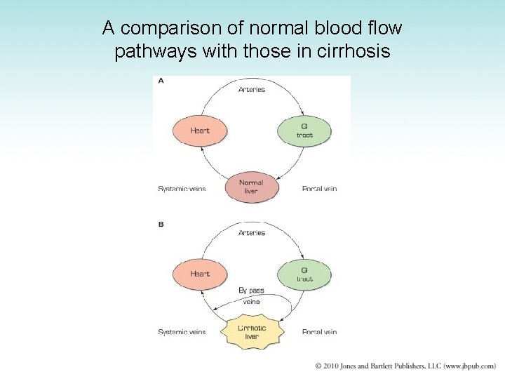 A comparison of normal blood flow pathways with those in cirrhosis 