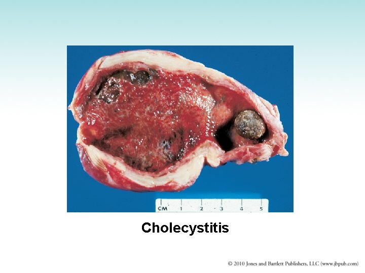 Cholecystitis 