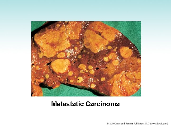 Metastatic Carcinoma 