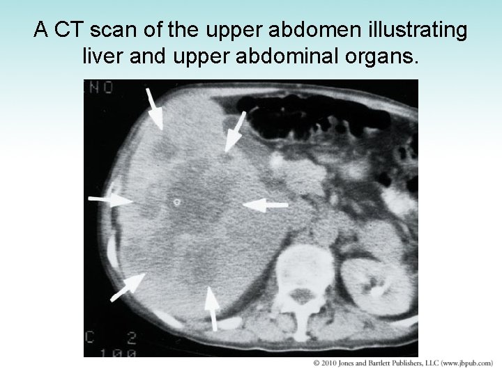 A CT scan of the upper abdomen illustrating liver and upper abdominal organs. 