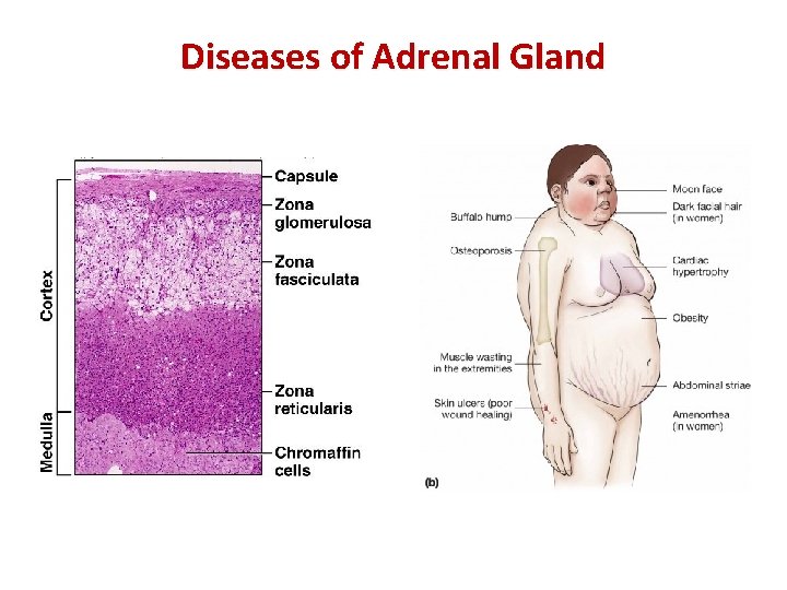 Diseases of Adrenal Gland 