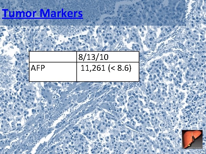 Tumor Markers AFP 8/13/10 11, 261 (< 8. 6) 