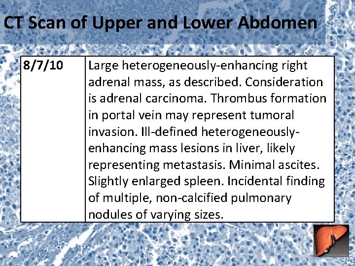 CT Scan of Upper and Lower Abdomen 8/7/10 Large heterogeneously-enhancing right adrenal mass, as