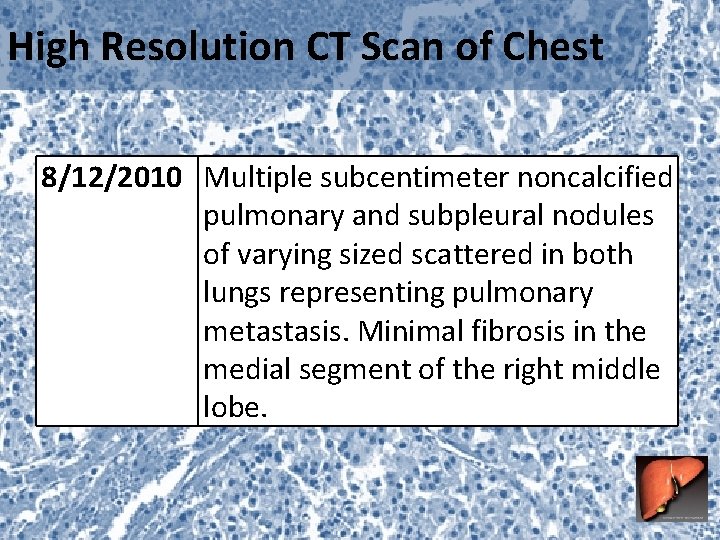 High Resolution CT Scan of Chest 8/12/2010 Multiple subcentimeter noncalcified pulmonary and subpleural nodules