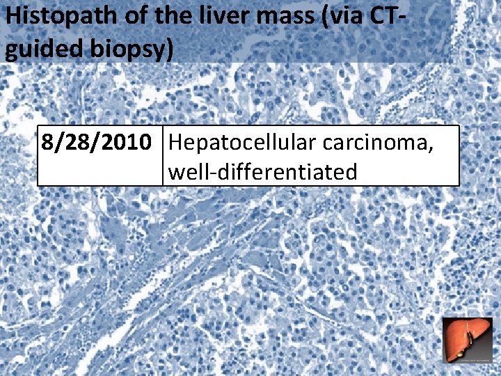 Histopath of the liver mass (via CTguided biopsy) 8/28/2010 Hepatocellular carcinoma, well-differentiated 