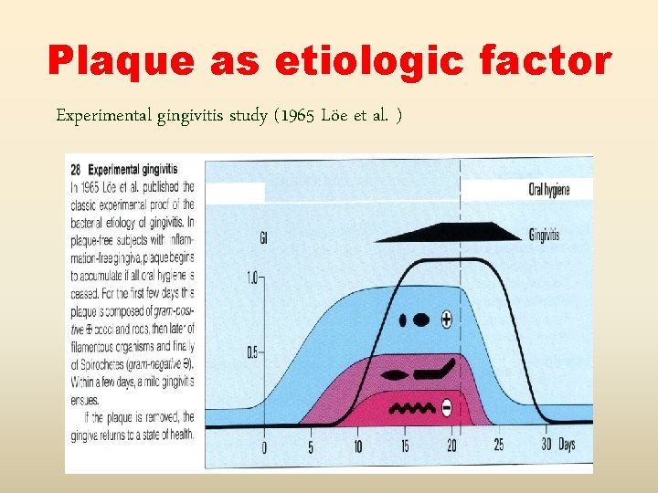 Plaque as etiologic factor Experimental gingivitis study (1965 Löe et al. ) 