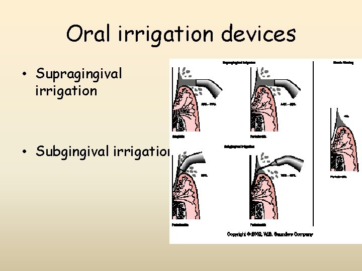 Oral irrigation devices • Supragingival irrigation • Subgingival irrigation 
