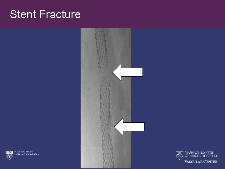 Stent Fracture 