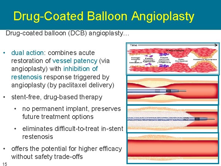 Drug-Coated Balloon Angioplasty Drug-coated balloon (DCB) angioplasty… • dual action: combines acute restoration of