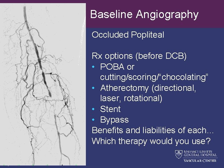 Baseline Angiography Occluded Popliteal Rx options (before DCB) • POBA or cutting/scoring/“chocolating” • Atherectomy