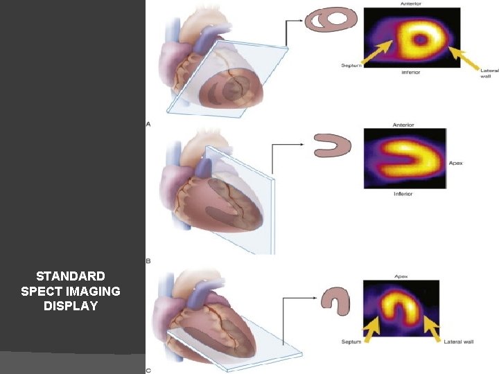 SA VLA STANDARD SPECT IMAGING DISPLAY HLA 