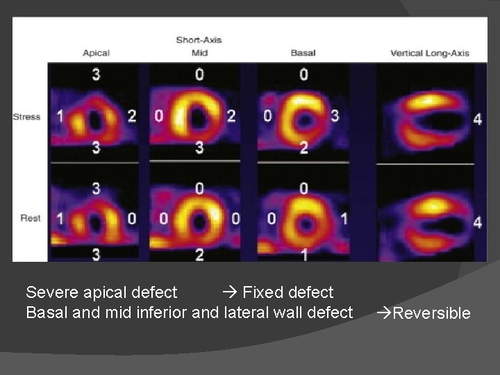  Fixed defect Severe apical defect Basal and mid inferior and lateral wall defect