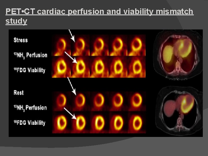 PET • CT cardiac perfusion and viability mismatch study 