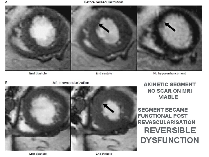 AKINETIC SEGMENT NO SCAR ON MRI VIABLE SEGMENT BECAME FUNCTIONAL POST REVASCULARISATION REVERSIBLE DYSFUNCTION