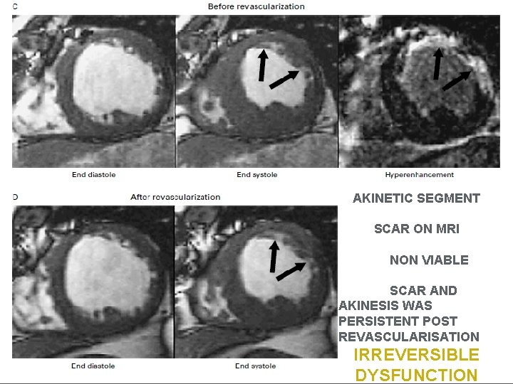 AKINETIC SEGMENT SCAR ON MRI NON VIABLE SCAR AND AKINESIS WAS PERSISTENT POST REVASCULARISATION