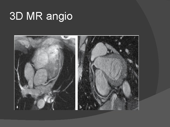 3 D MR angio 