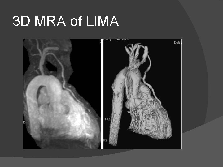 3 D MRA of LIMA 