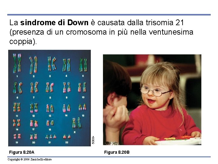 5000 La sindrome di Down è causata dalla trisomia 21 (presenza di un cromosoma
