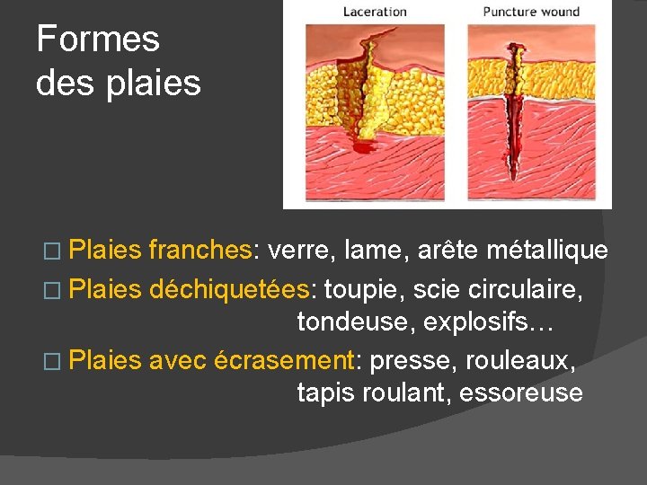 Formes des plaies � Plaies franches: verre, lame, arête métallique � Plaies déchiquetées: toupie,