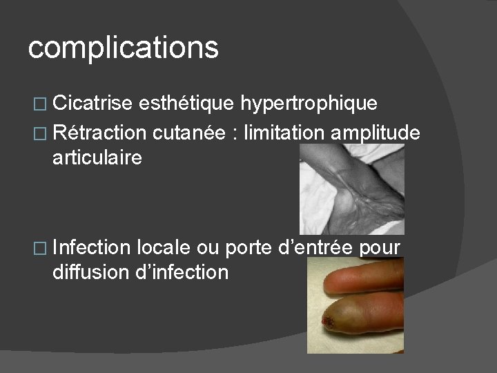 complications � Cicatrise esthétique hypertrophique � Rétraction cutanée : limitation amplitude articulaire � Infection