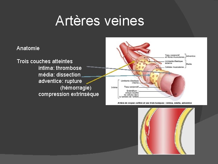 Artères veines Anatomie Trois couches atteintes intima: thrombose média: dissection adventice: rupture (hémorragie) compression