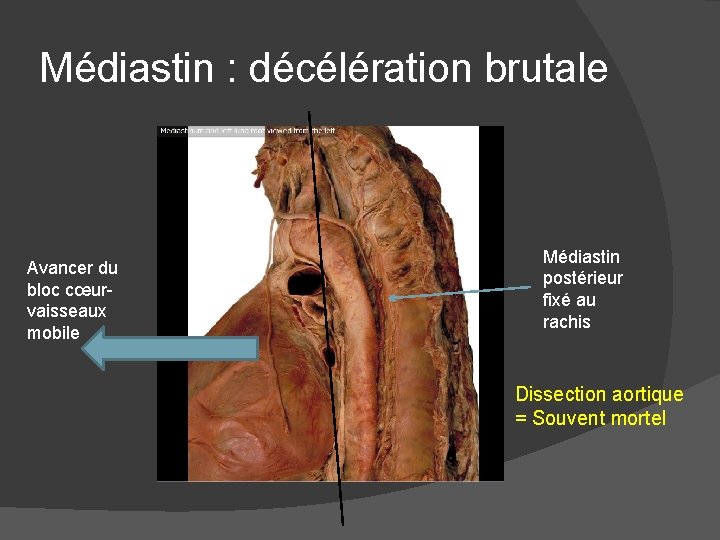 Médiastin : décélération brutale Avancer du bloc cœurvaisseaux mobile Médiastin postérieur fixé au rachis