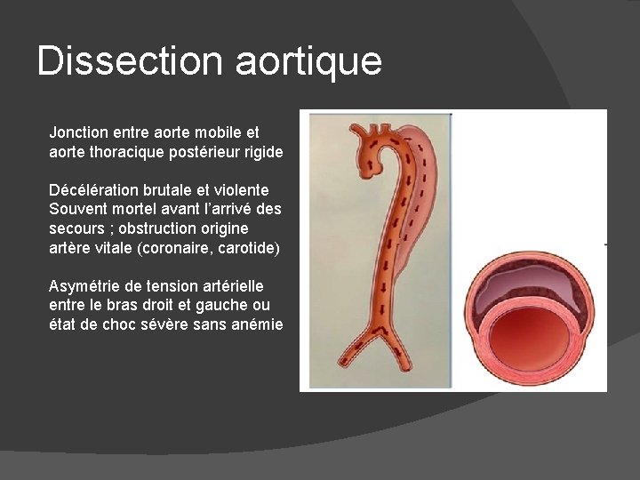 Dissection aortique Jonction entre aorte mobile et aorte thoracique postérieur rigide Décélération brutale et