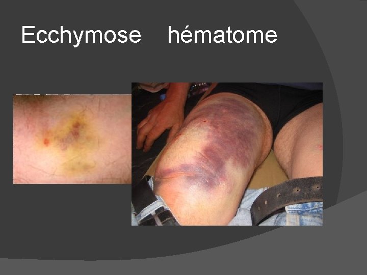 Ecchymose hématome 