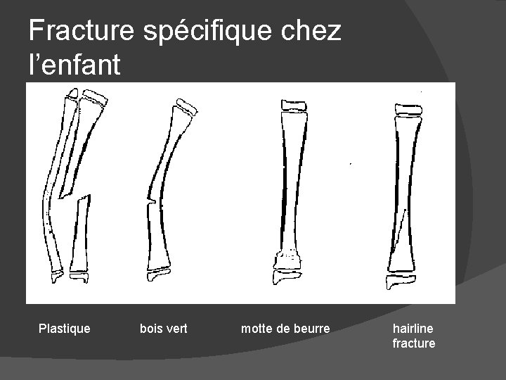 Fracture spécifique chez l’enfant Plastique bois vert motte de beurre hairline fracture 