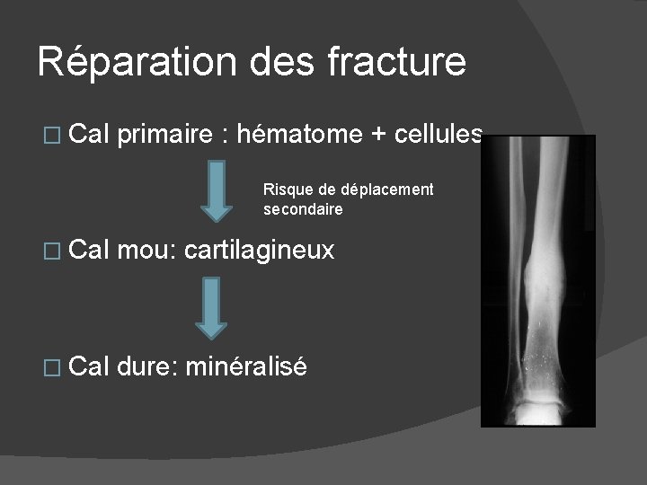 Réparation des fracture � Cal primaire : hématome + cellules Risque de déplacement secondaire