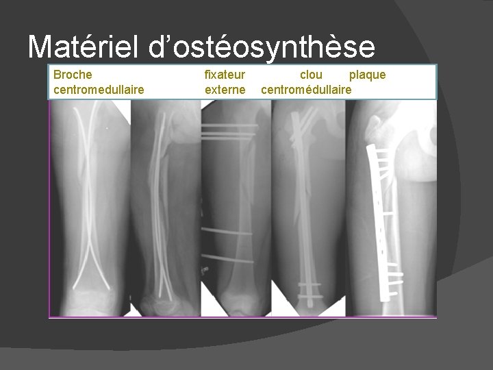 Matériel d’ostéosynthèse Broche centromedullaire fixateur externe clou plaque centromédullaire 