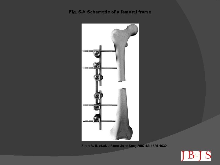 Fig. 5 -A Schematic of a femoral frame Ziran B. H. et. al. J
