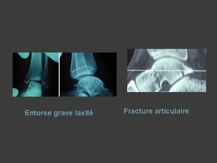 Entorse grave laxité Fracture articulaire 