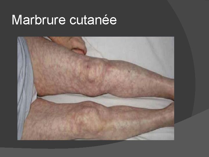 Marbrure cutanée 