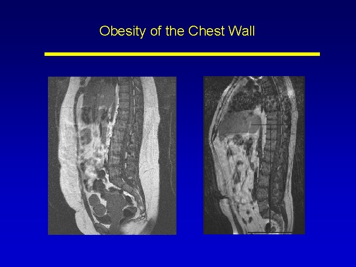 Obesity of the Chest Wall 