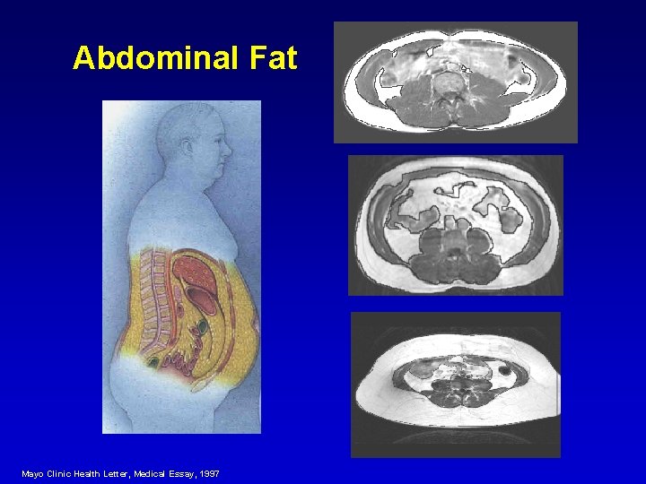 Abdominal Fat Mayo Clinic Health Letter, Medical Essay, 1997 